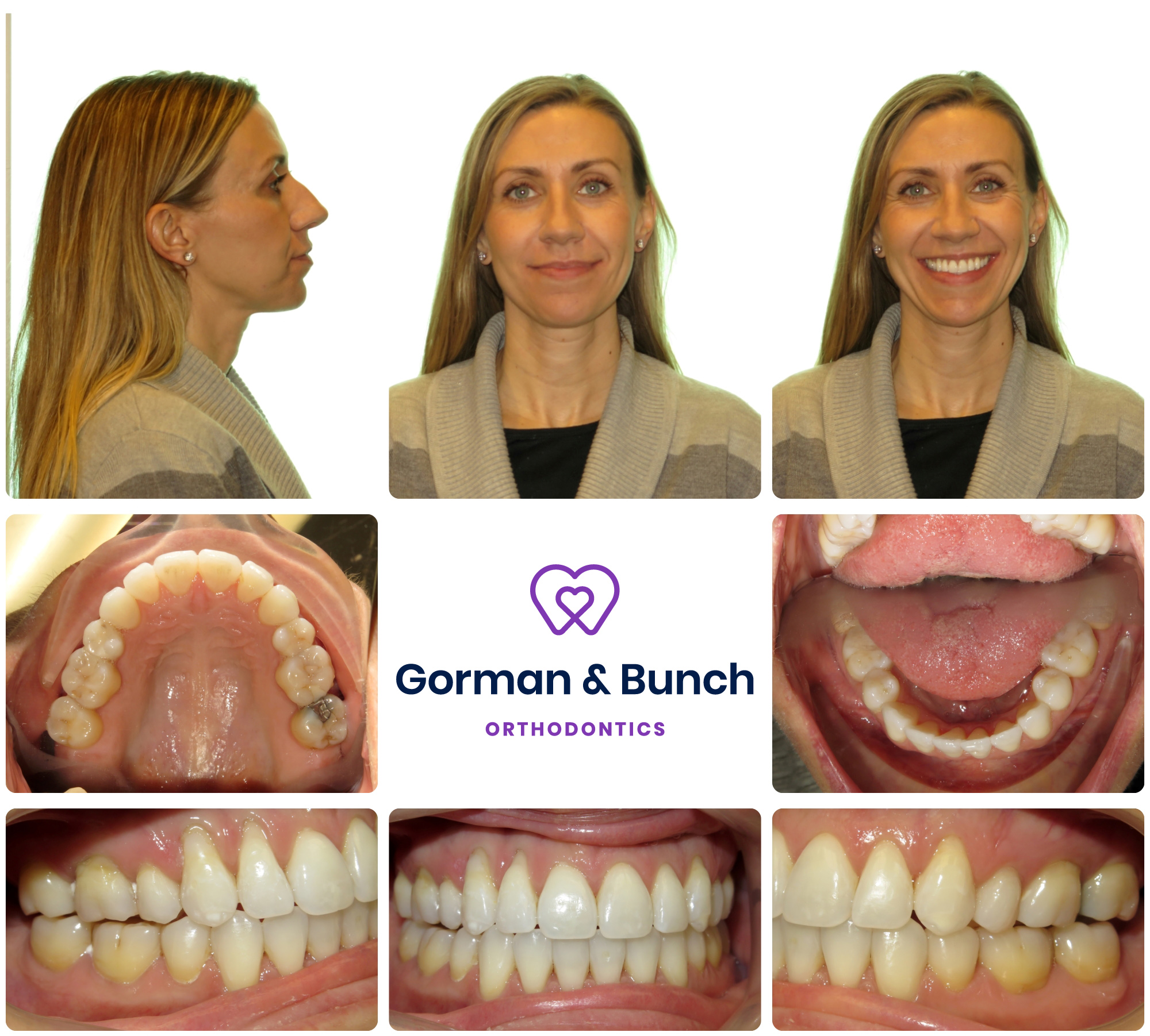 invisalign before and after - open bite - carmel indiana - jk - 2